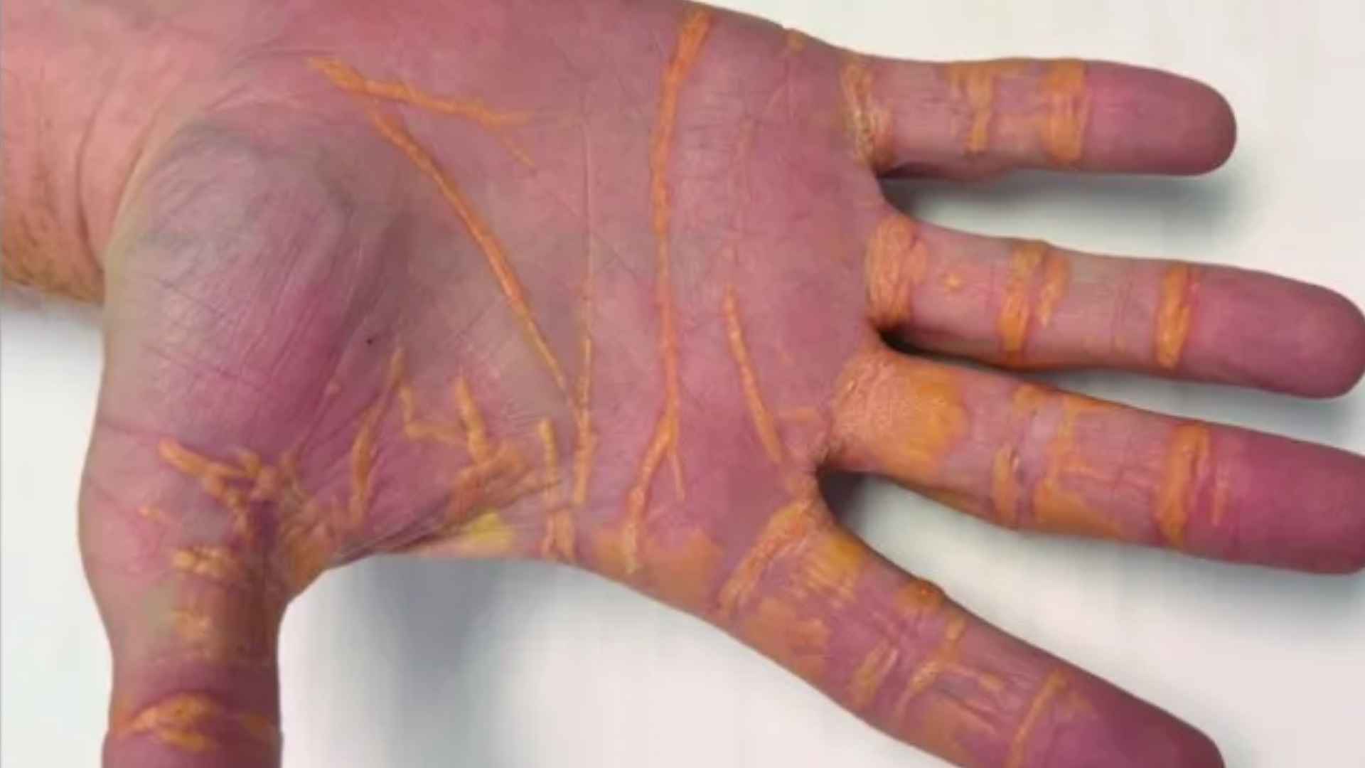 Close-up of a man’s hand showing yellow-orange cholesterol buildup caused by prolonged high-fat carnivore diet