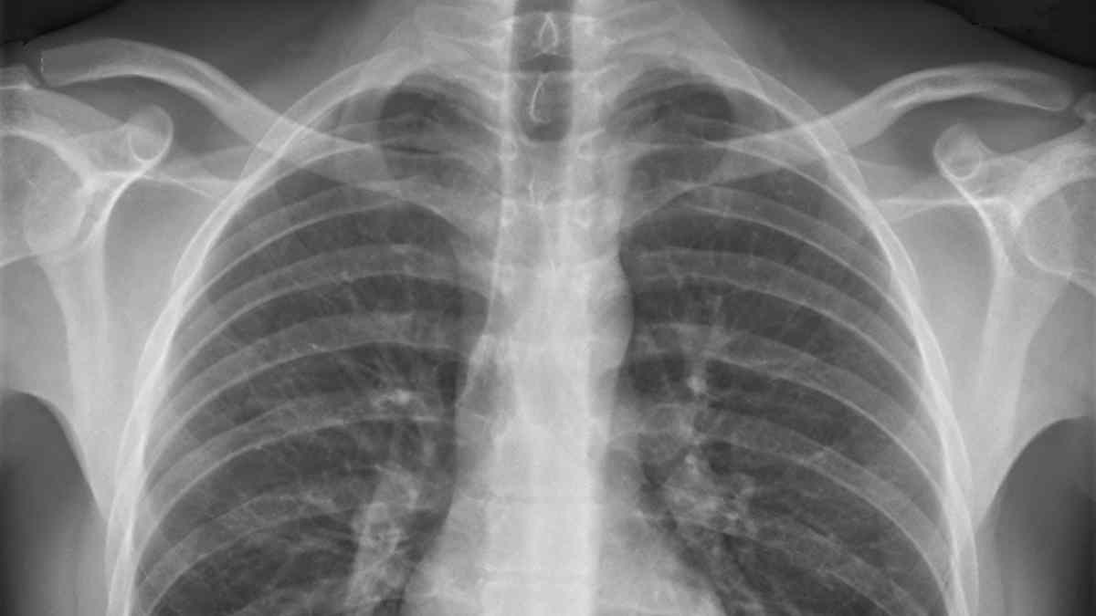 Radiografía de tórax con silicosis provocada por polvo de sílice al cortar encimeras de piedra artificial