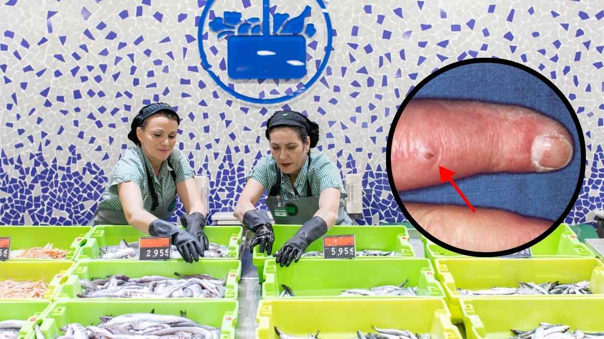 Trabajadoras de la pescadería de Mercadona; detalle del dedo lesionado por espina que provocó incapacidad permanente parcial
