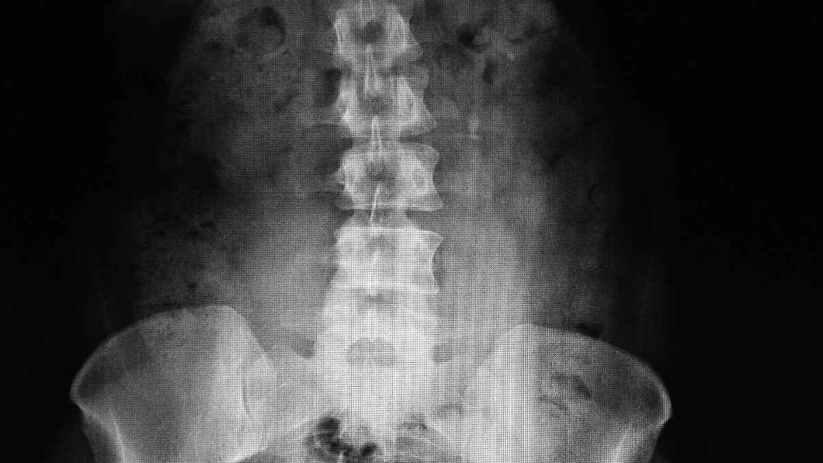 Radiografía de la columna lumbar con artrodesis mostrando el síndrome de espalda fallida tras varias cirugías.