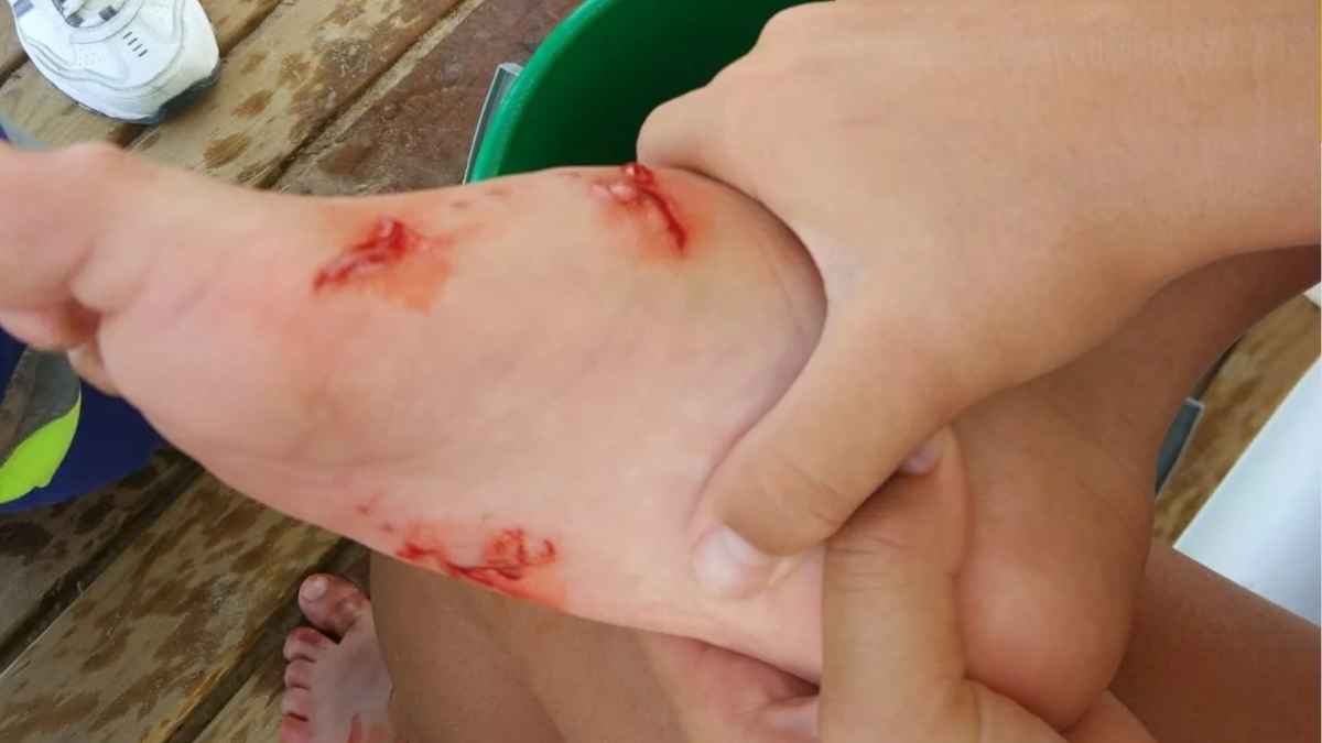 Picadura dolorosa de pez araña en el pie de un bañista tras pisarlo bajo la arena de una playa de Alicante