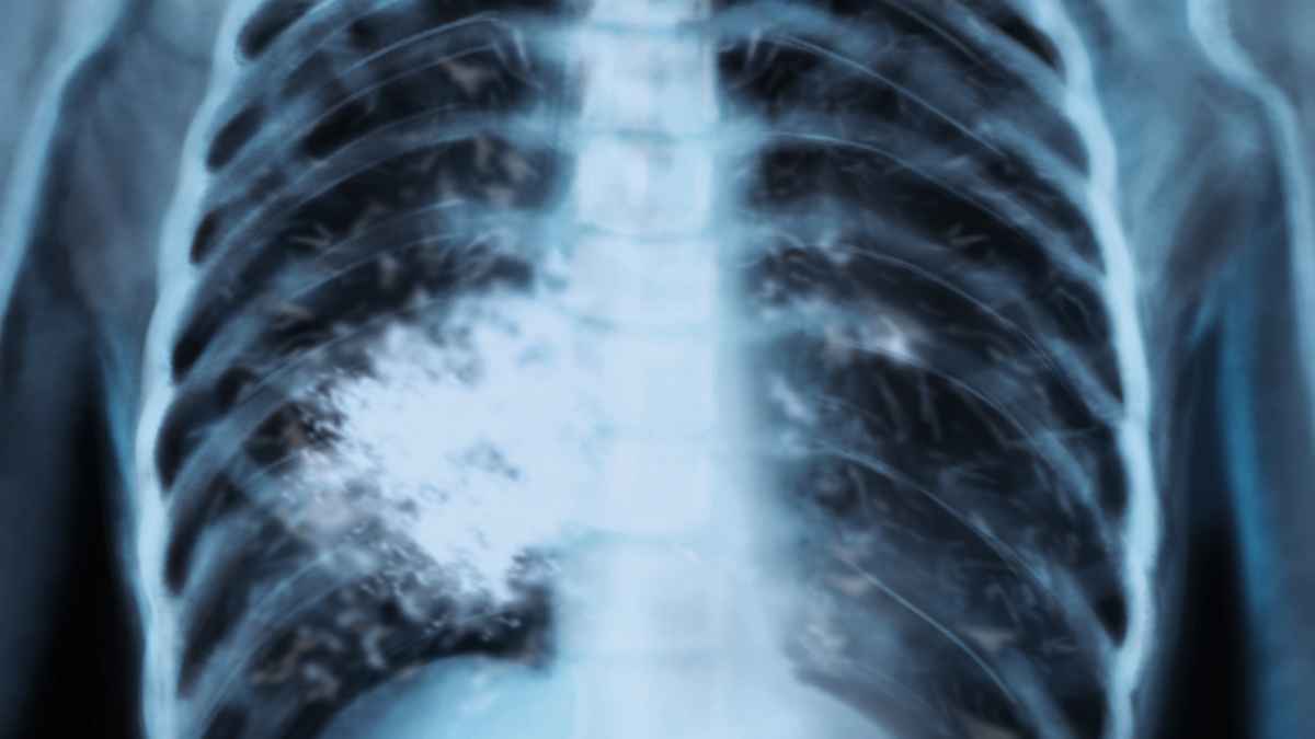 Radiografía de tórax con lesión pulmonar compatible con cáncer