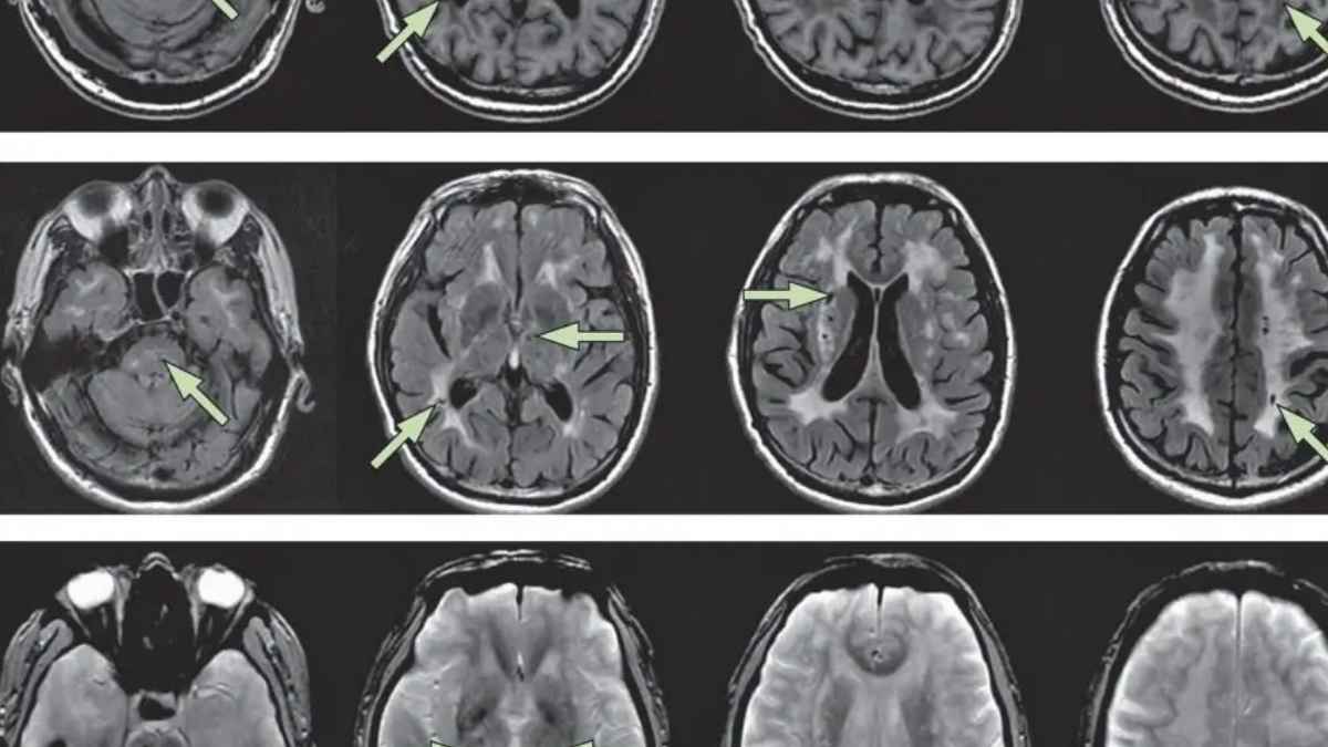 Resonancia cerebral de paciente con enfermedad de Cadasil que recibe pensión vitalicia por incapacidad permanente