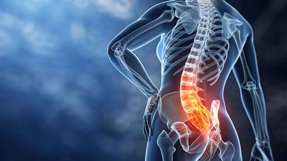 Ilustración médica de la columna vertebral con dolor lumbar relacionada con incapacidad permanente por síndrome de espalda fallida