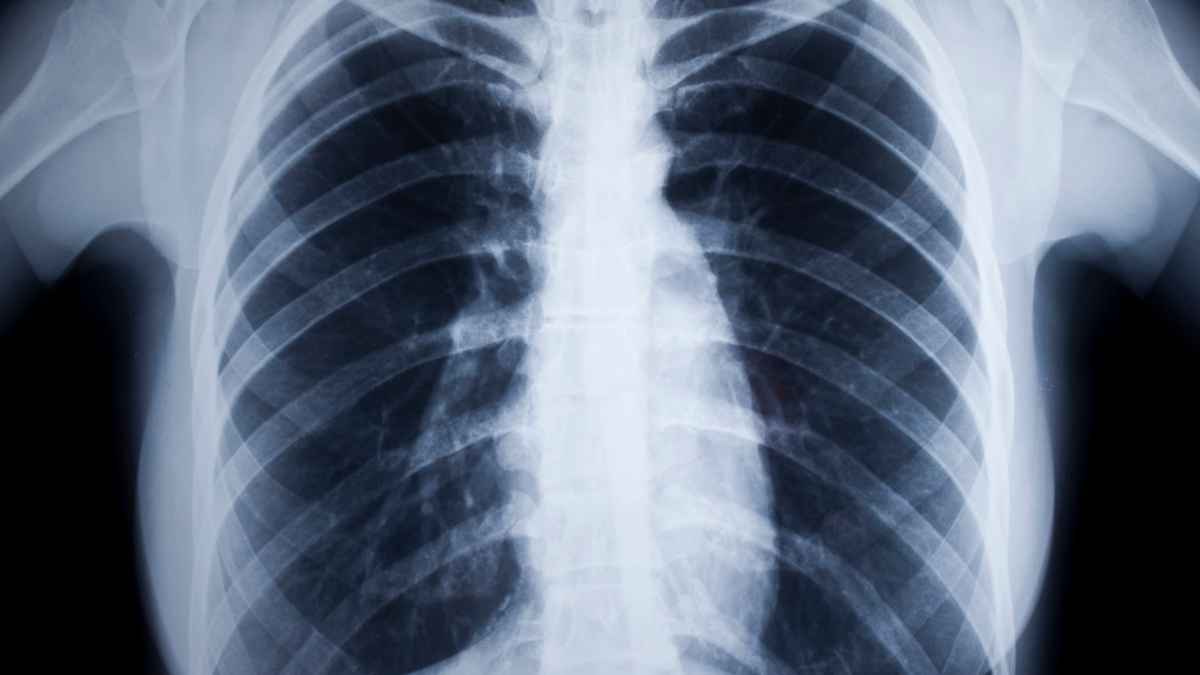 Radiografía médica en blanco y negro usada como imagen ilustrativa en una noticia sobre gran invalidez por espalda fallida