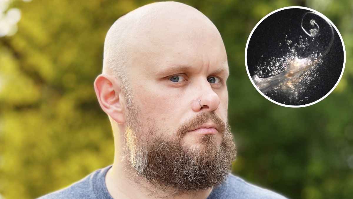 Hombre calvo con barba y detalle de un folículo capilar en una imagen sobre los avances contra la alopecia