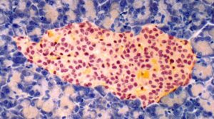 Científicos logran revertir la diabetes tipo 1 con células madre de insulina mejoradas creadas en laboratorio
