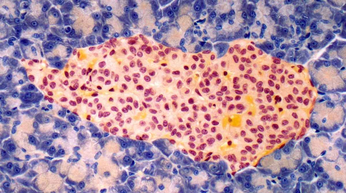 células pancreáticas productoras de insulina creadas a partir de células madre para tratar la diabetes tipo 1