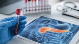 Estados Unidos aprueba una nueva terapia oral para cáncer de páncreas metastásico