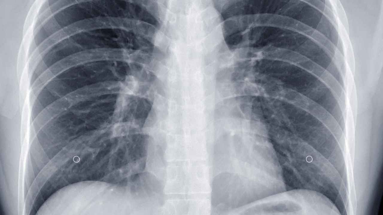 Radiografía de tórax de una paciente con varias patologías asociadas a una incapacidad permanente