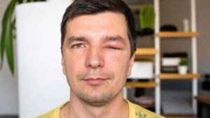 Un soldador pierde la visión de un ojo, agota 545 días de baja y gana al INSS